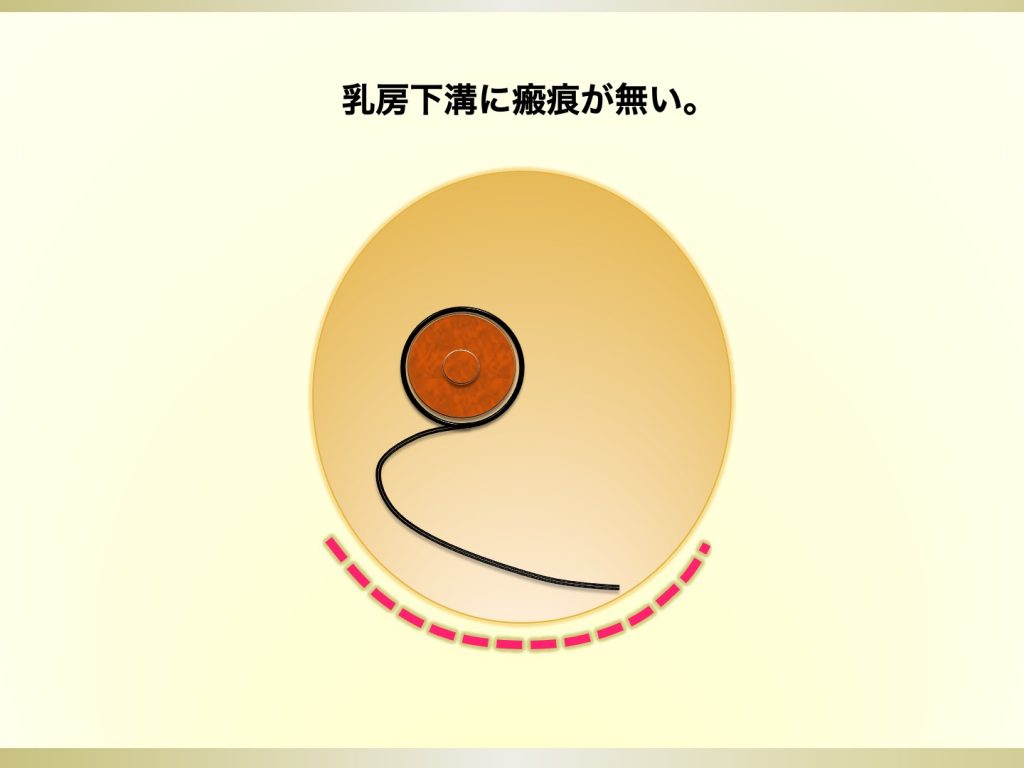 乳房縮小術 乳房固定術の新しいかたち Br Clinic Ginza 